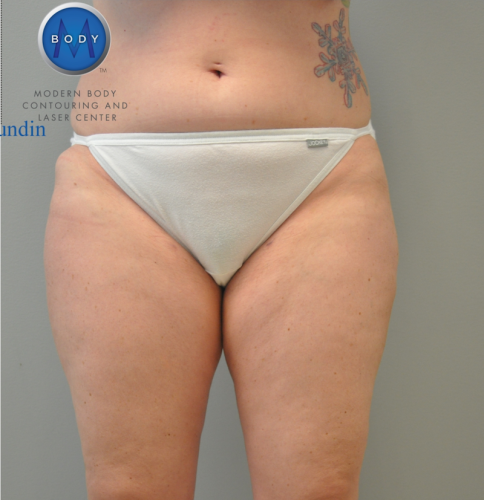 Liposuction Before and After | Little Lipo