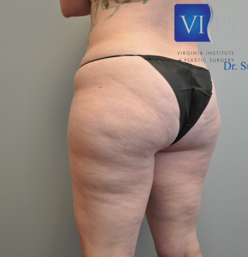Liposuction Before and After | Little Lipo