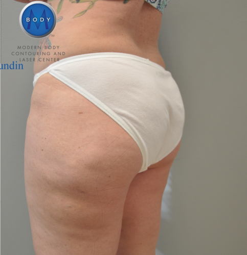 Liposuction Before and After | Little Lipo