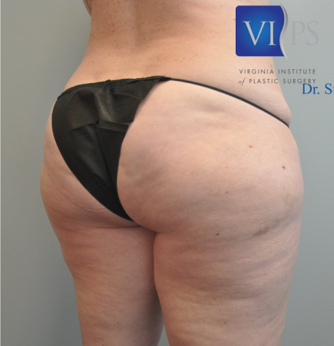 Liposuction Before and After | Little Lipo