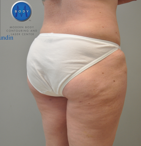 Liposuction Before and After | Little Lipo
