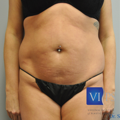 Liposuction Before and After | Little Lipo