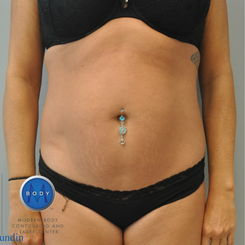 Liposuction Before and After | Little Lipo