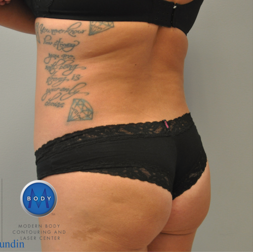 Liposuction Before and After | Little Lipo