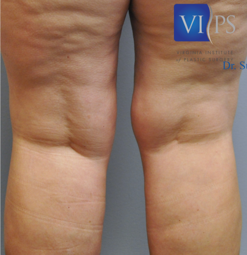 Liposuction Before and After | Little Lipo