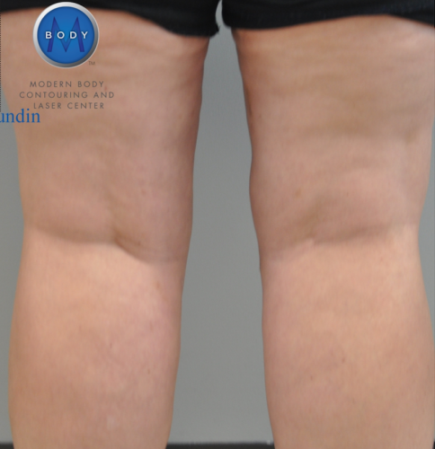 Liposuction Before and After | Little Lipo