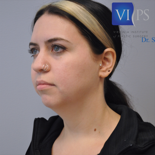 Liposuction Before and After | Little Lipo