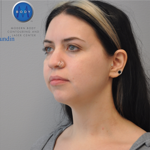 Liposuction Before and After | Little Lipo