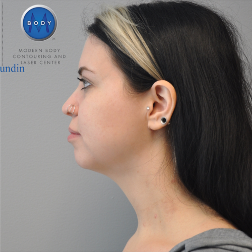 Liposuction Before and After | Little Lipo