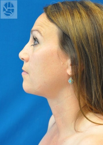 Liposuction Before and After | Little Lipo