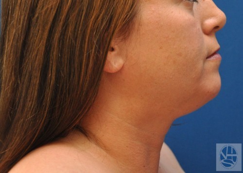 Liposuction Before and After | Little Lipo