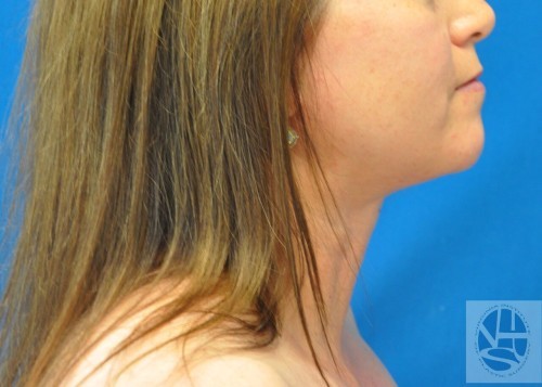 Liposuction Before and After | Little Lipo