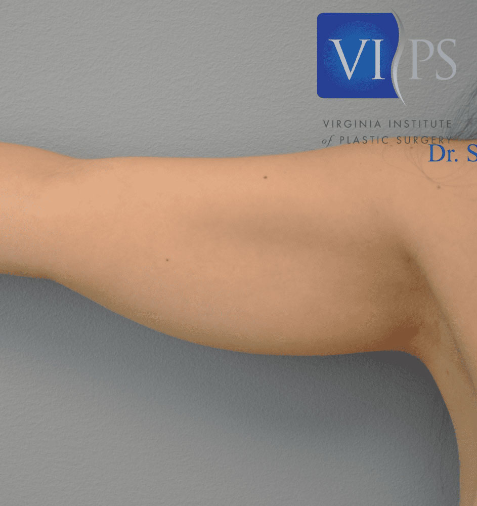 Liposuction Before and After | Little Lipo