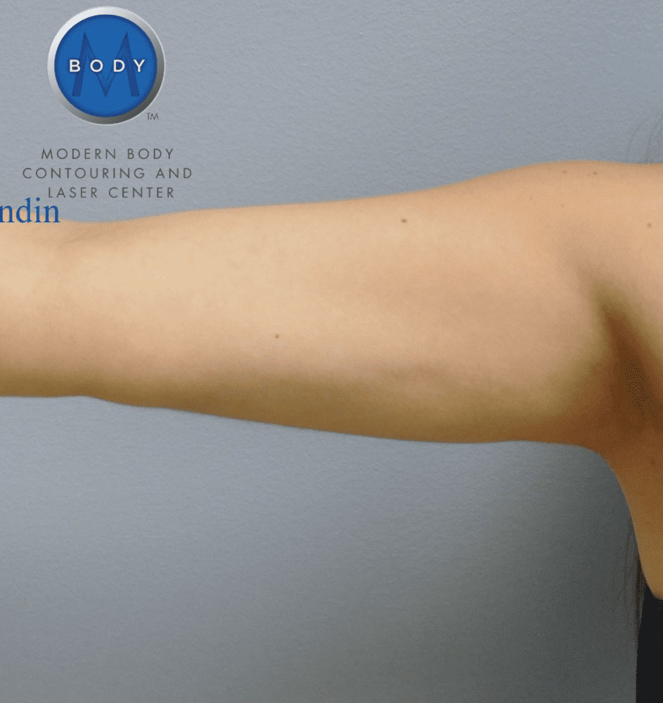 Liposuction Before and After | Little Lipo