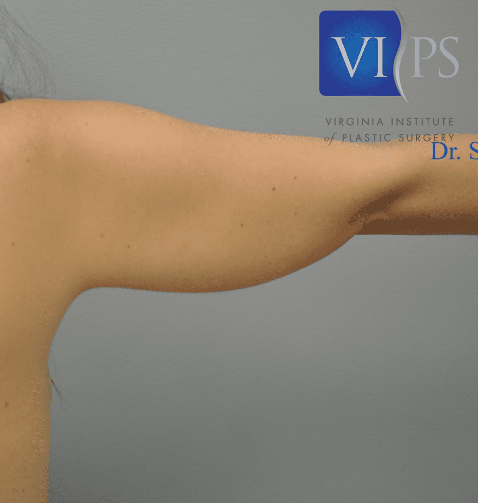 Liposuction Before and After | Little Lipo