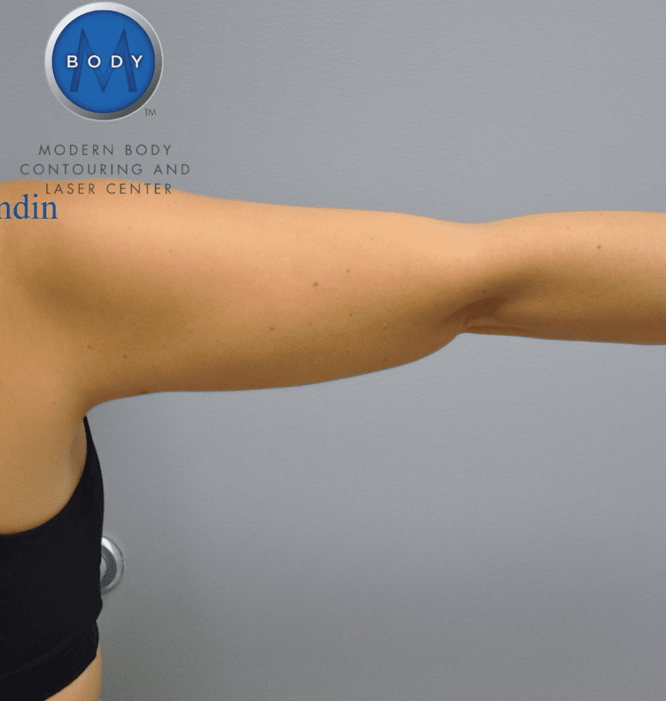 Liposuction Before and After | Little Lipo