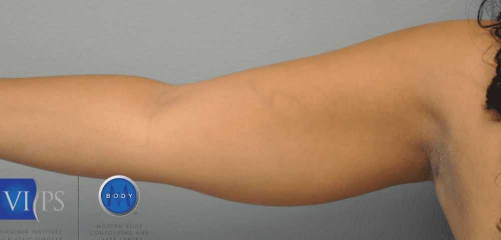 Liposuction Before and After | Little Lipo