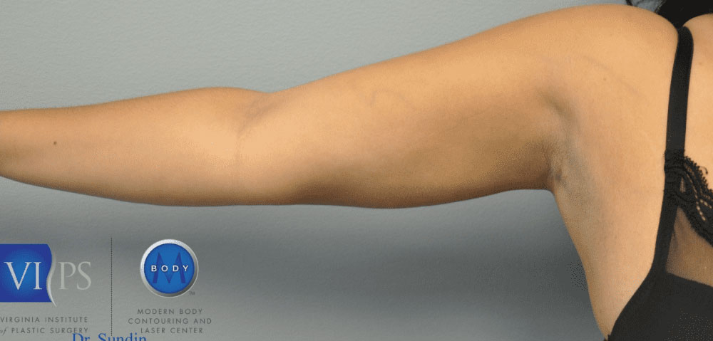 Liposuction Before and After | Little Lipo
