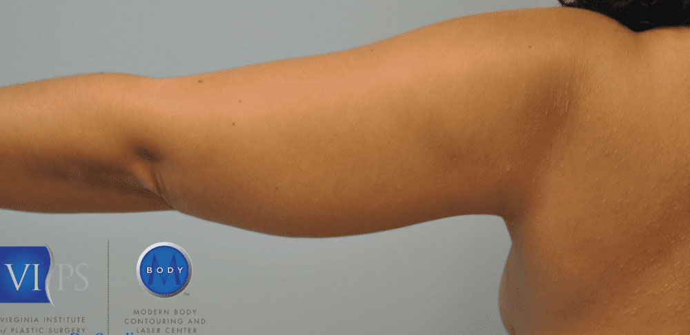 Liposuction Before and After | Little Lipo
