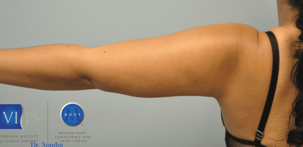 Liposuction Before and After | Little Lipo