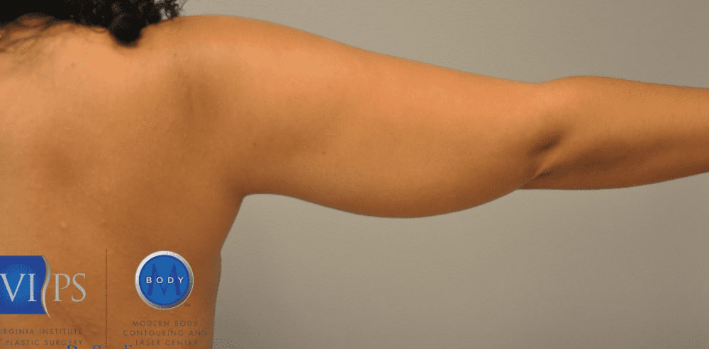 Liposuction Before and After | Little Lipo