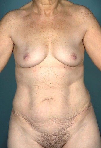 Mommy Makeover Before and After | Little Lipo