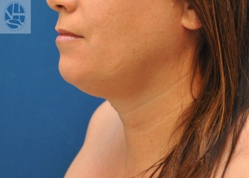 Neck Liposuction Before and After | Little Lipo