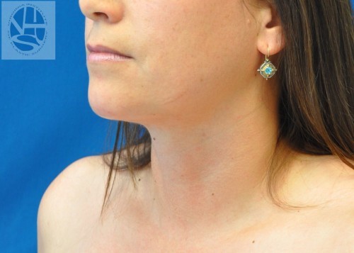 Neck Liposuction Before and After | Little Lipo