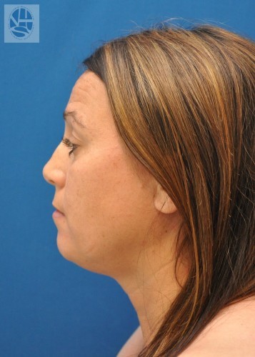Neck Liposuction Before and After | Little Lipo