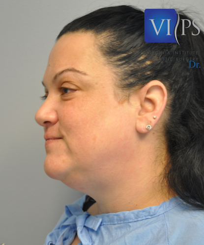 Neck Liposuction Before and After | Little Lipo