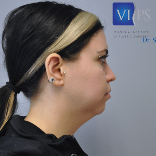 Neck Liposuction Before and After | Little Lipo