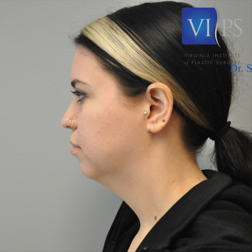 Neck Liposuction Before and After | Little Lipo