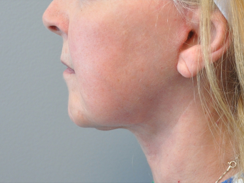 Necklift Before and After | Little Lipo