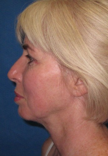 Necklift Before and After | Little Lipo