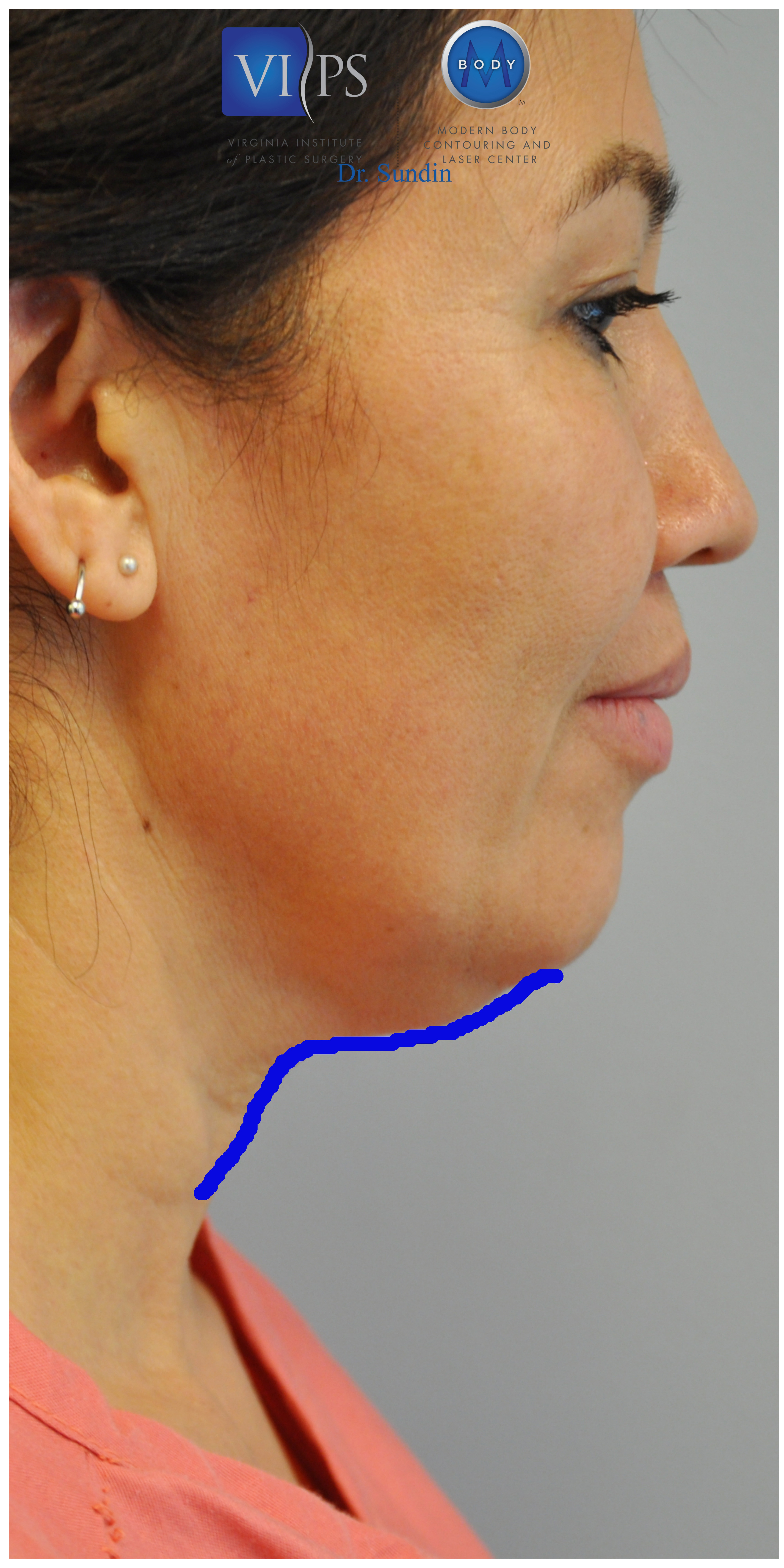 Necklift Before and After | Little Lipo