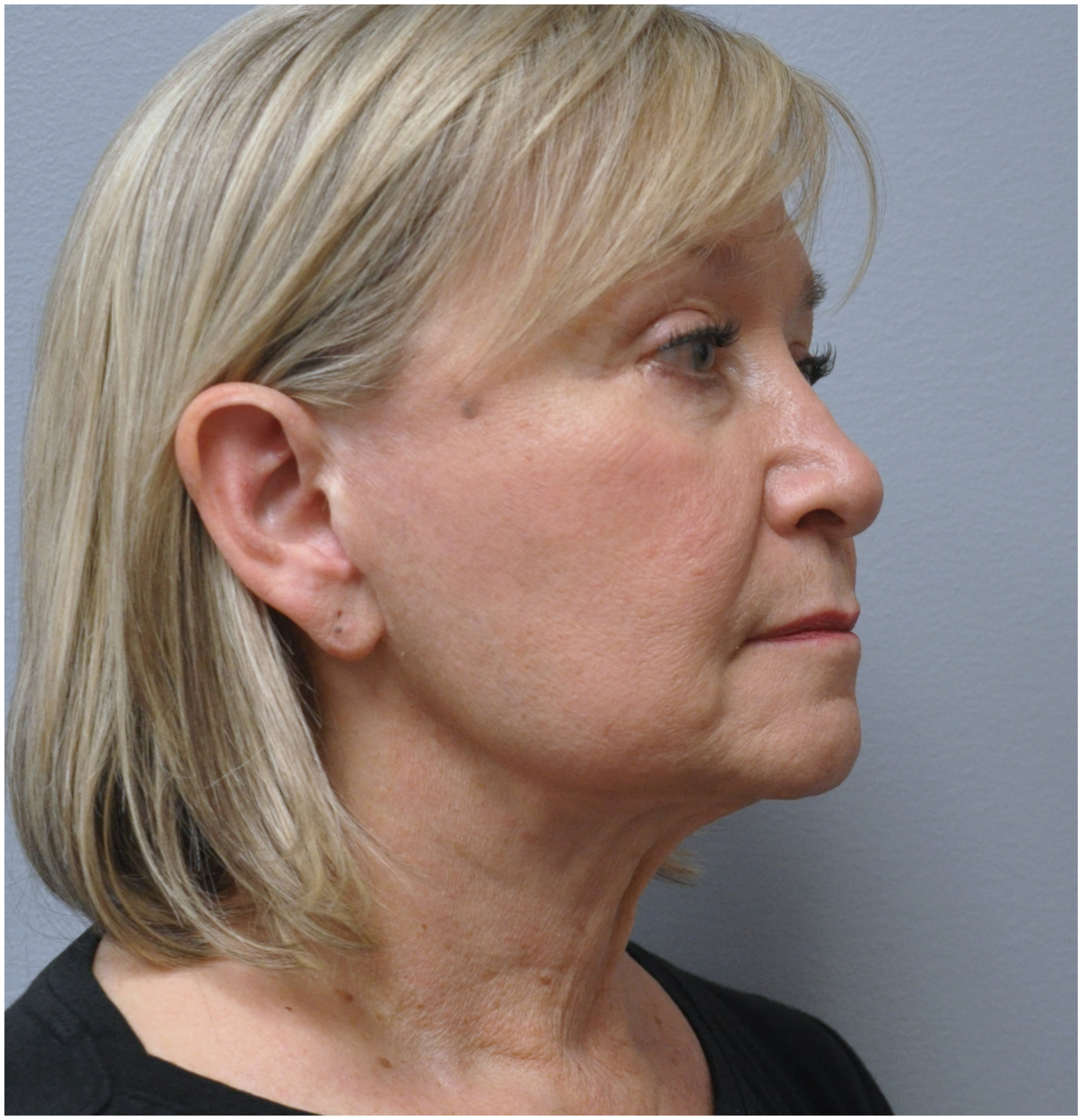 Necklift Before and After | Little Lipo