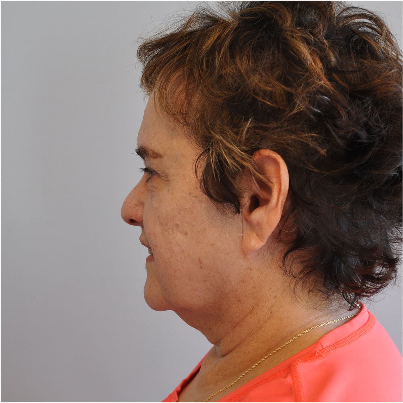 Necklift Before and After | Little Lipo
