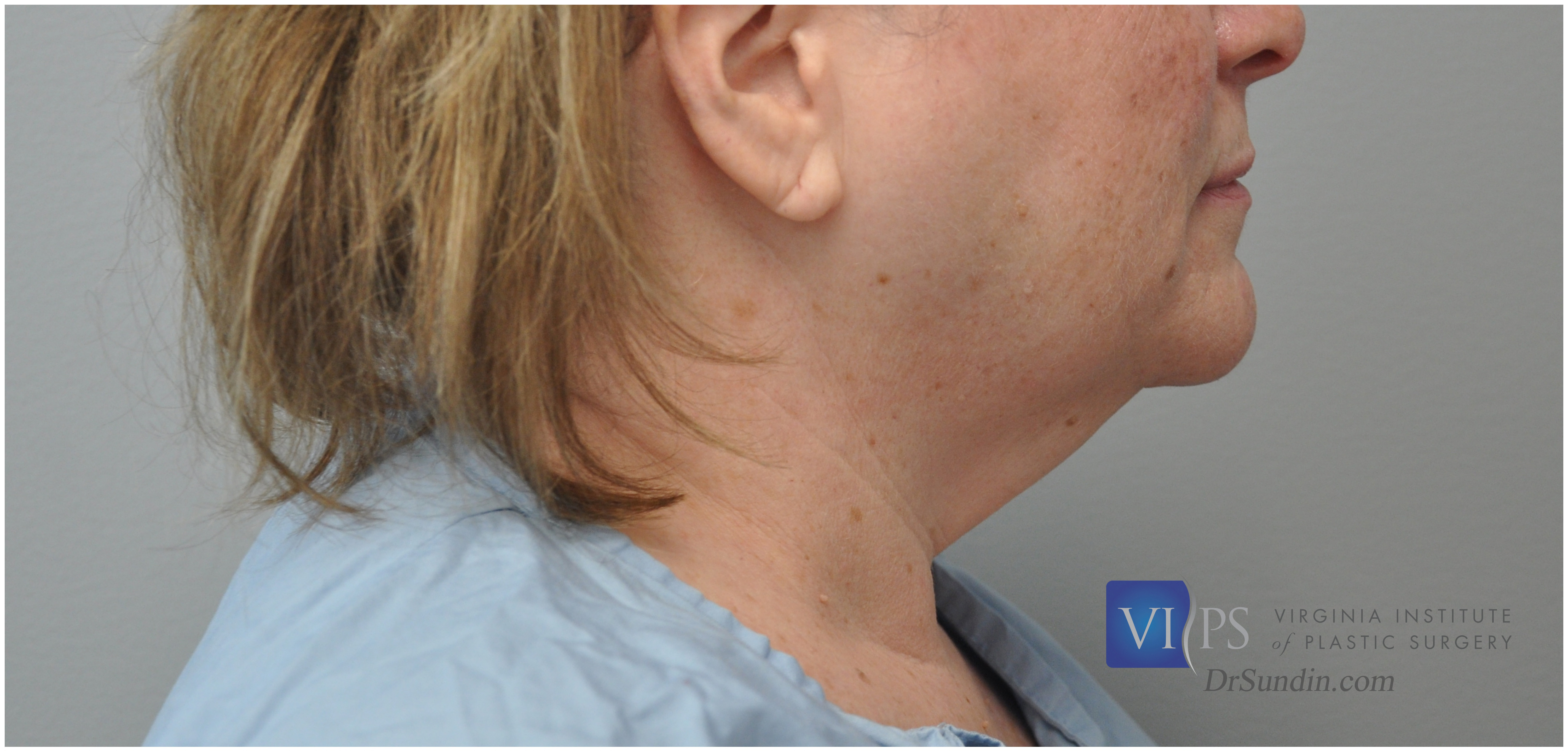 Necklift Before and After | Little Lipo