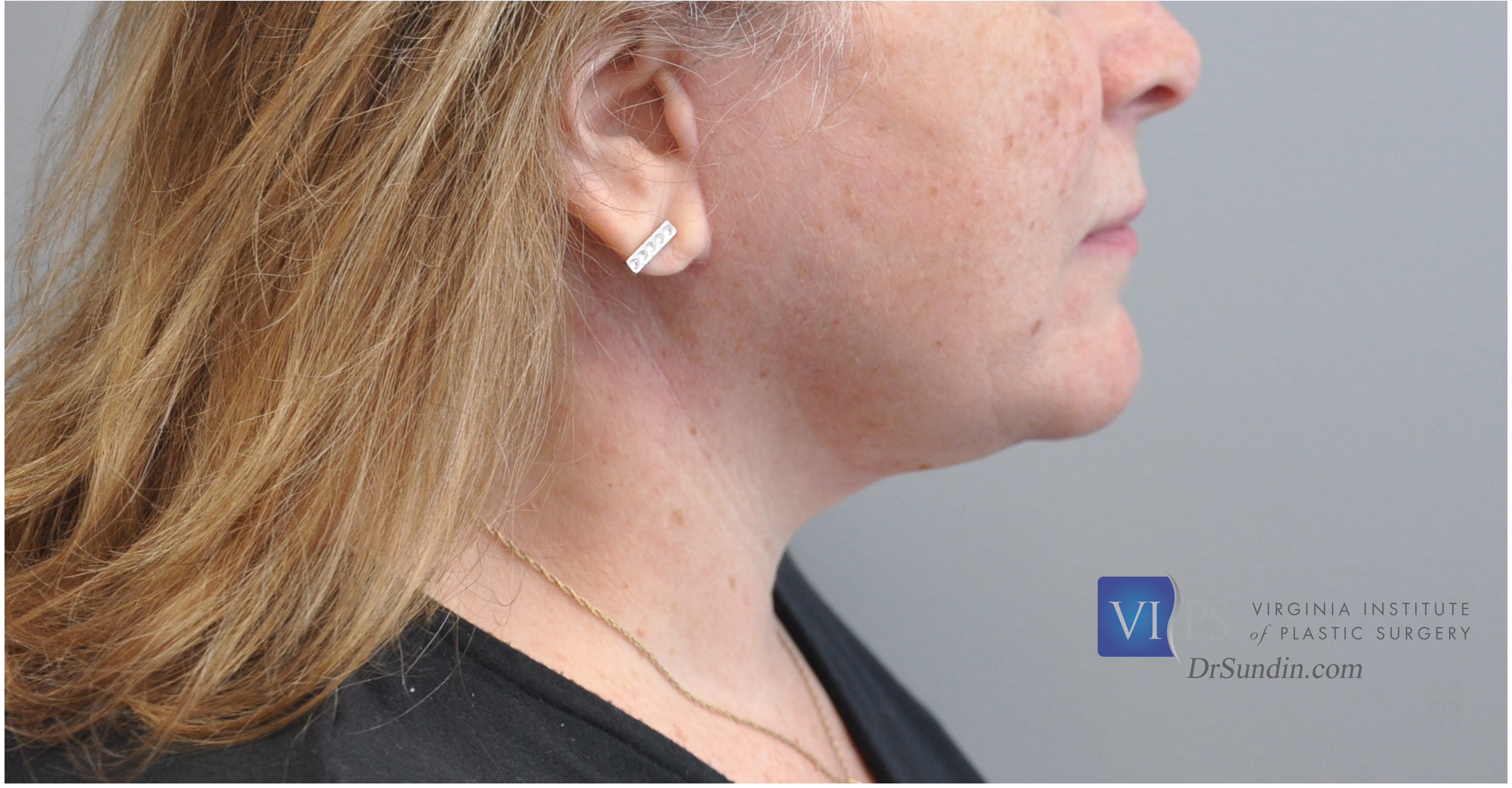 Necklift Before and After | Little Lipo