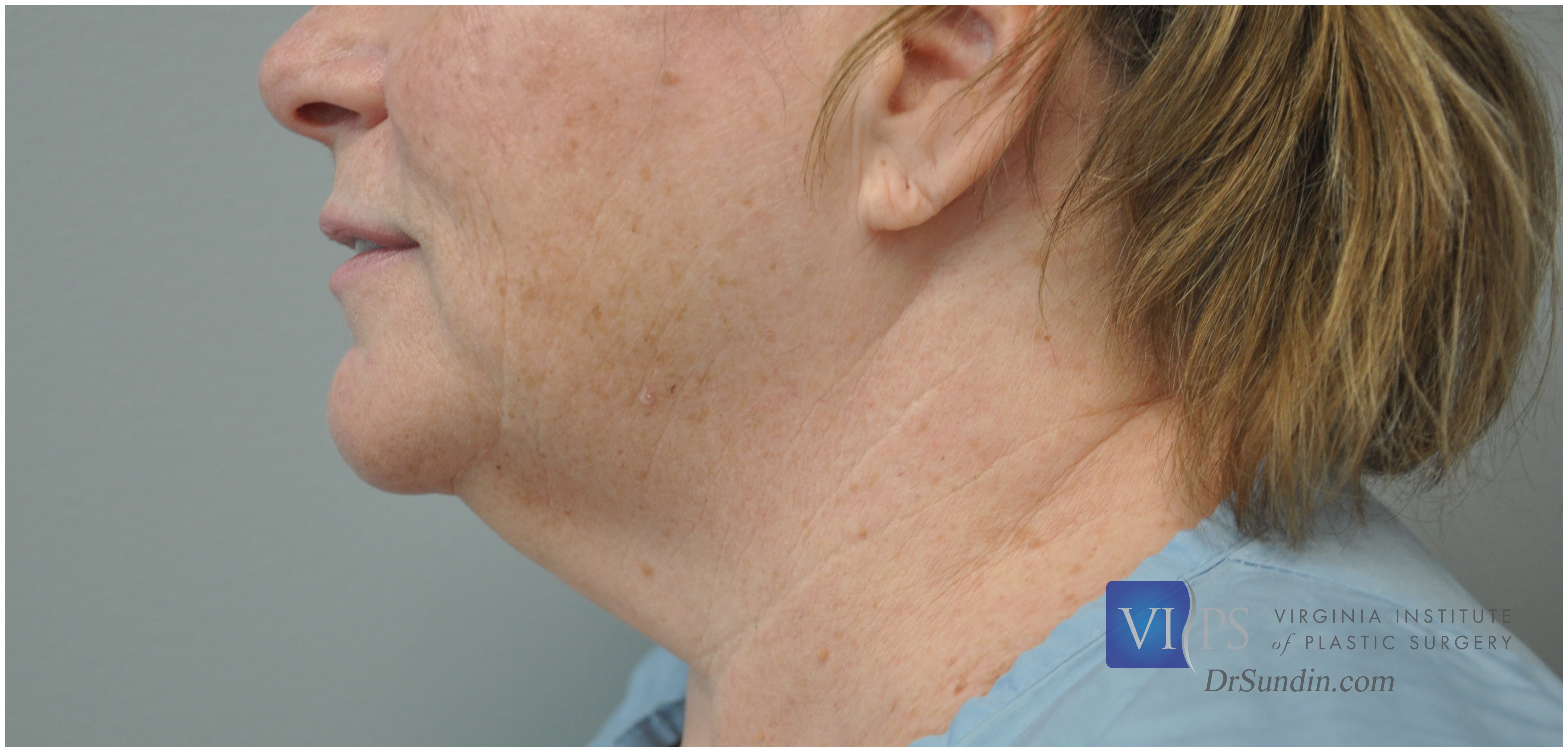 Necklift Before and After | Little Lipo