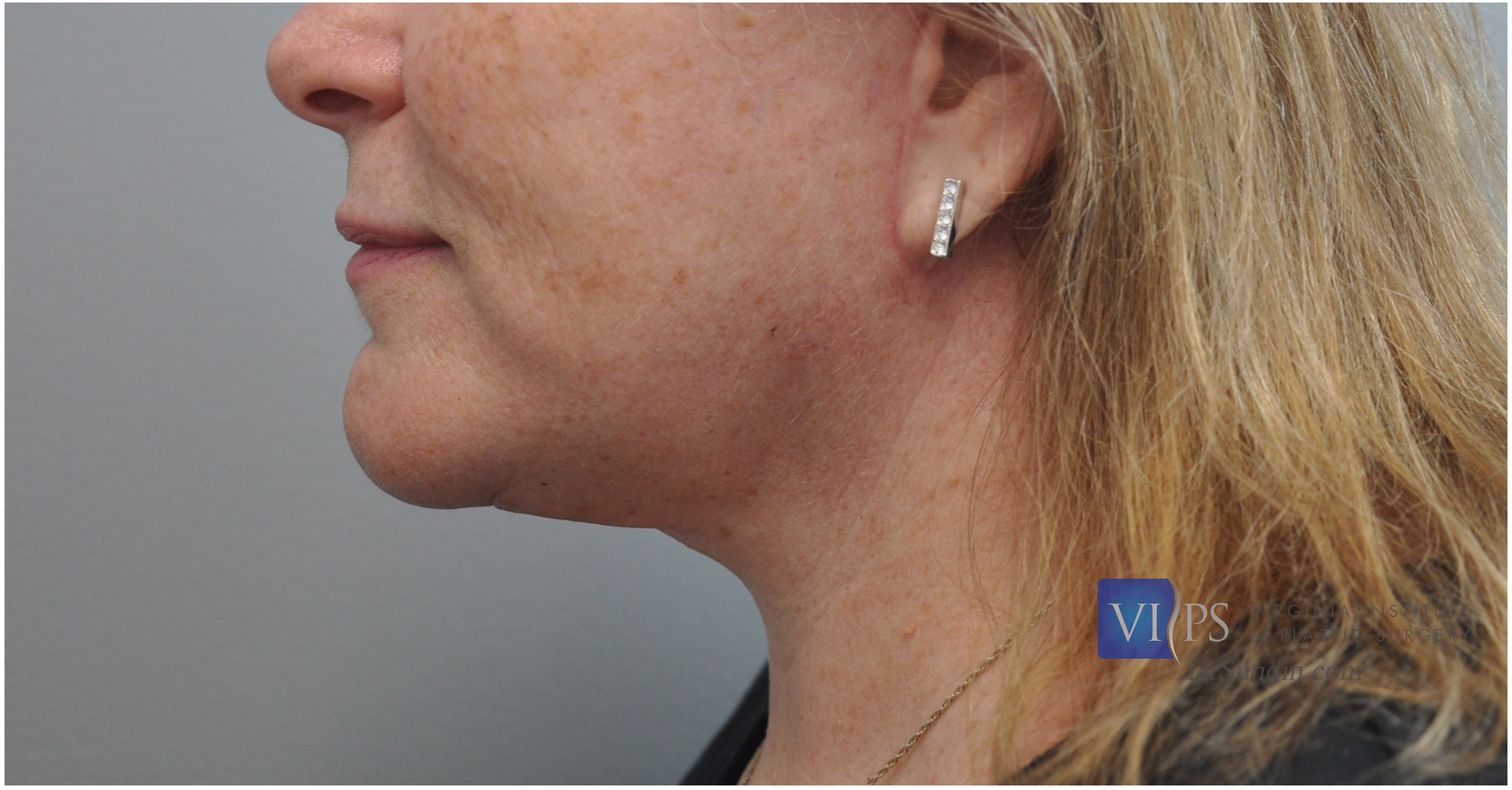 Necklift Before and After | Little Lipo