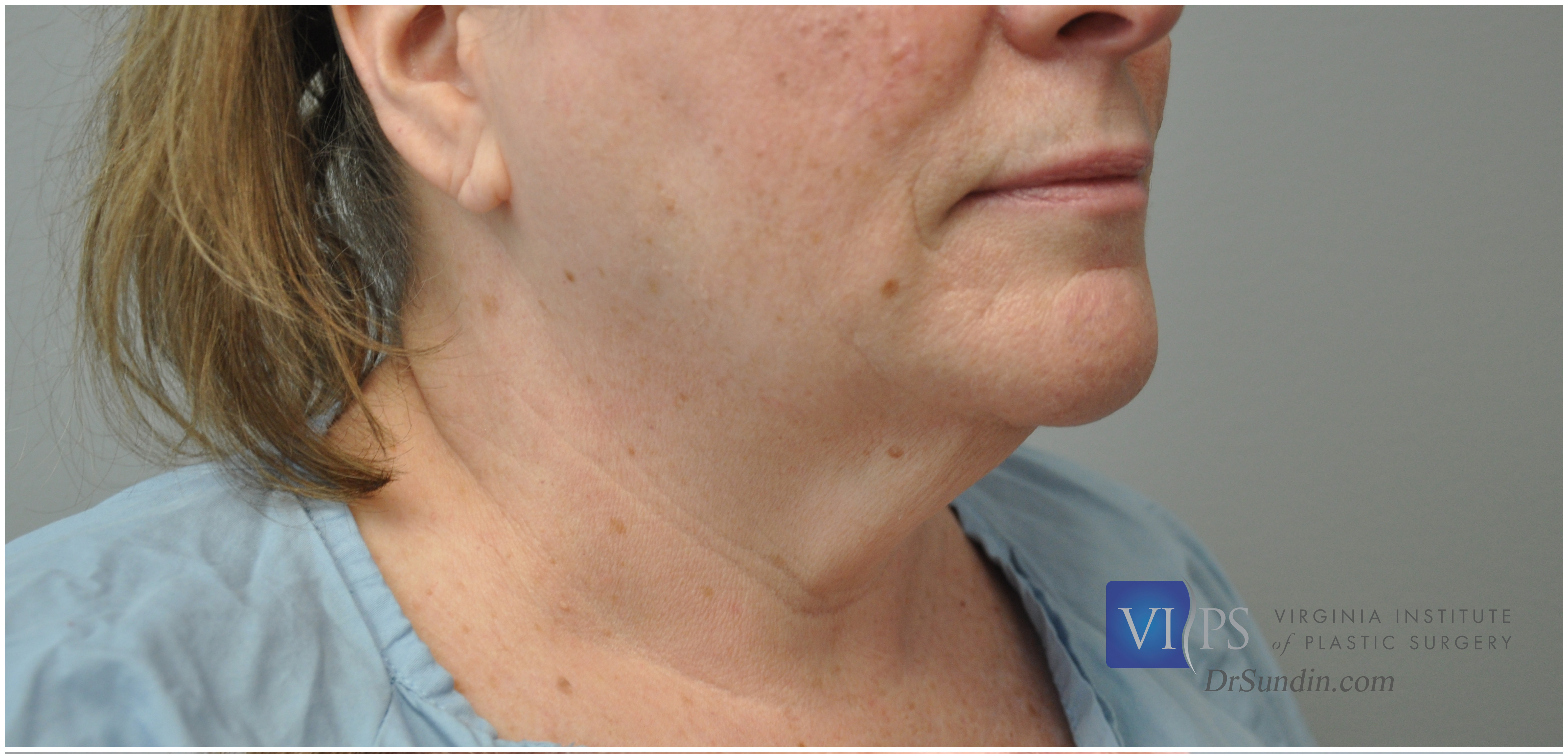 Necklift Before and After | Little Lipo