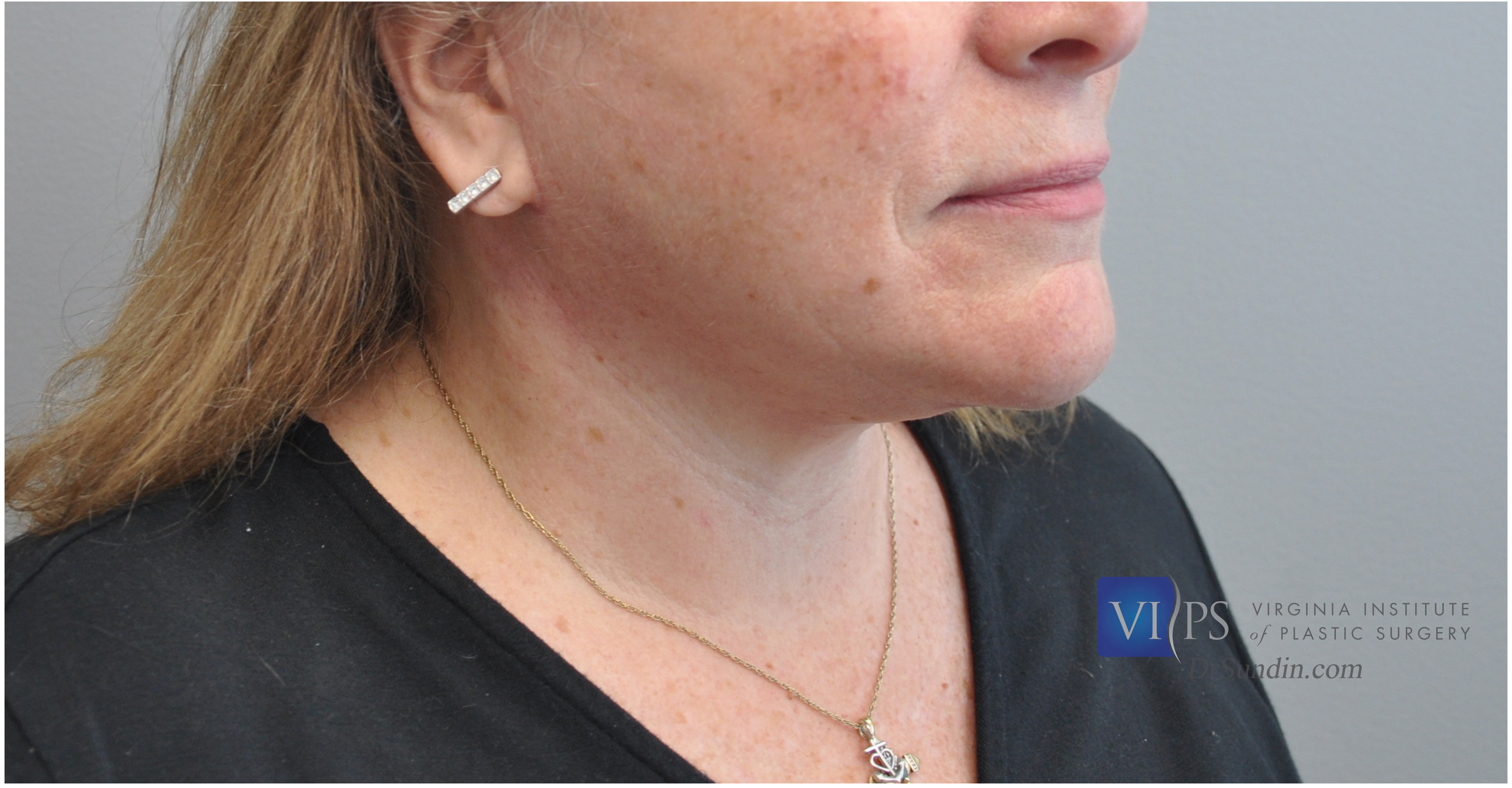 Necklift Before and After | Little Lipo