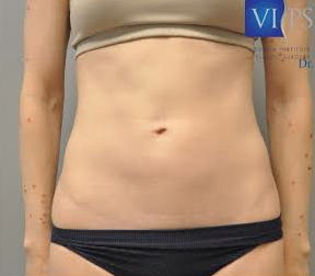 Renuvion J Plasma Before and After | Little Lipo