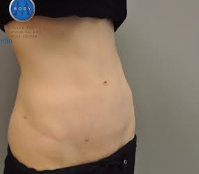 Renuvion J Plasma Before and After | Little Lipo