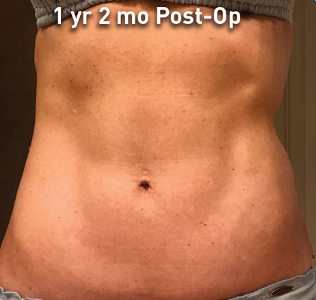 Renuvion J Plasma Before and After | Little Lipo