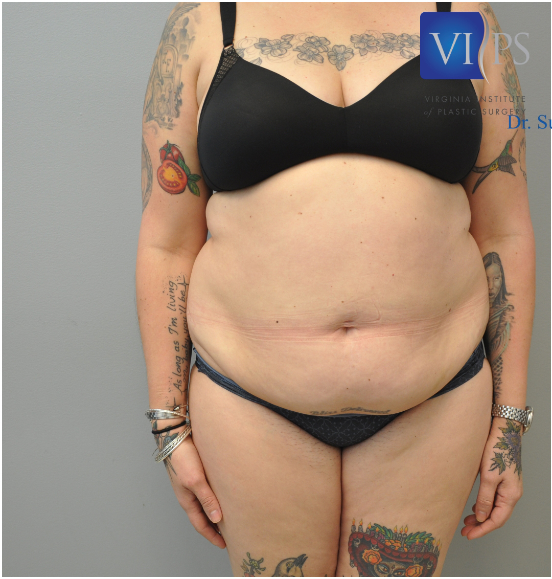 Renuvion J Plasma Before and After | Little Lipo
