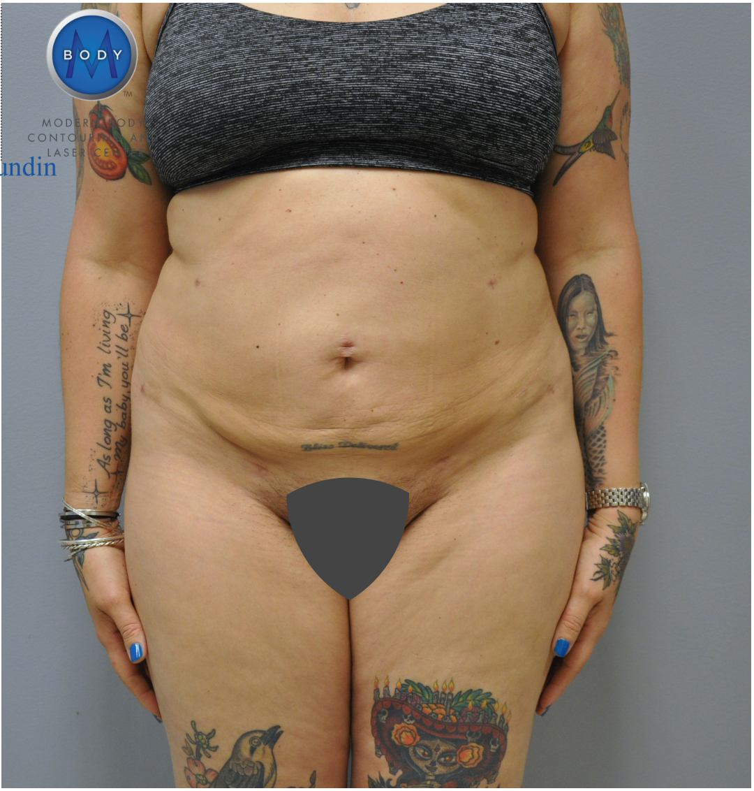 Renuvion J Plasma Before and After | Little Lipo