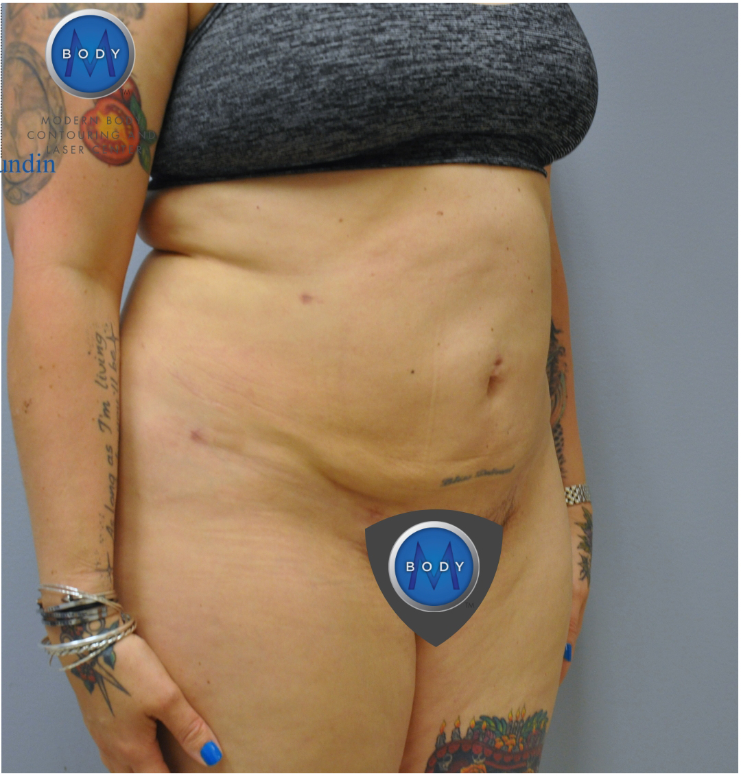 Renuvion J Plasma Before and After | Little Lipo