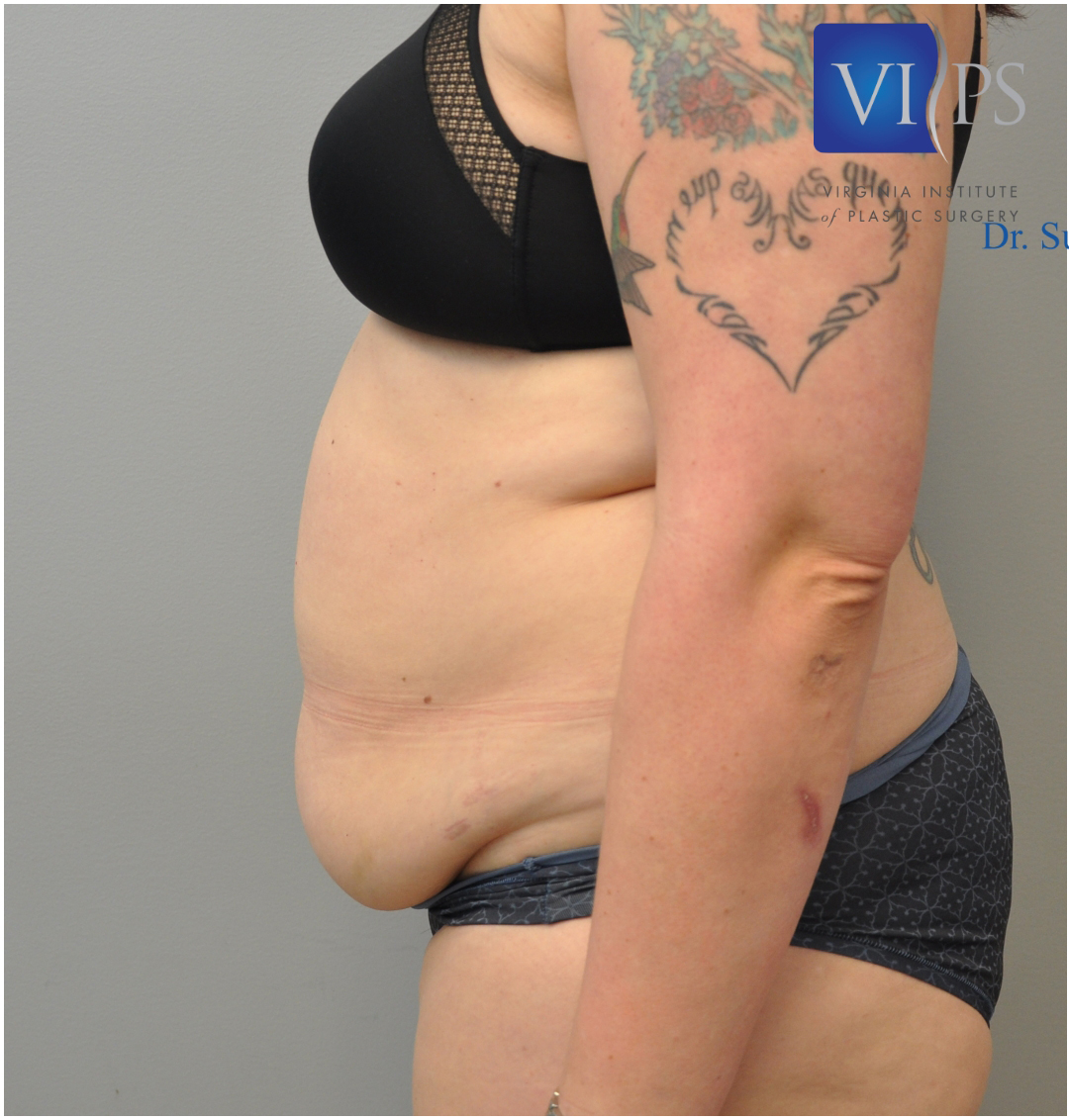 Renuvion J Plasma Before and After | Little Lipo